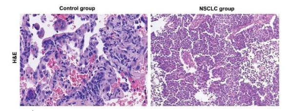 H and E stained tissue for normal cell type and the bronchogenic carcinoma cell type