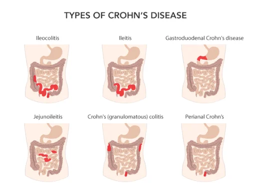 Types of Crohn’s disease