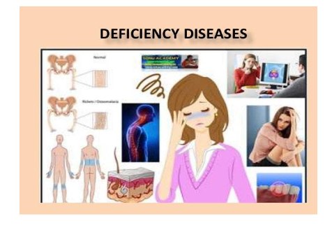Deficiency Diseases
